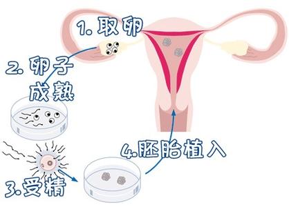 反覆流產